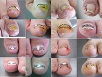 つくば市で陥入爪 巻き爪にお悩みなら いけがみ皮膚科