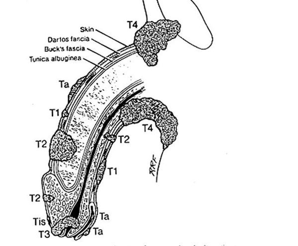 陰茎がんは亀頭だけに出来るのですか。 - 陰茎癌は亀頭だけに出来る物 