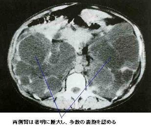 Yahoo!知恵袋私の持病が、多発性のう胞腎なんですけど
多発性腎のう胞とはどうちがうんですか、おしえてください。