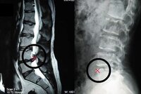 ぎっくり腰で病院に行き レントゲン撮ったけど骨には異常なしだったので電気治 Yahoo 知恵袋