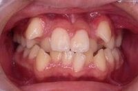 八重歯って正直 あんまり可愛くないですよね 歯並びが悪く見えるし 見た目がなん Yahoo 知恵袋