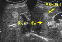 ３か月前に祖父がエコーの検査をした時に 肝臓に白い影が見えると Yahoo 知恵袋