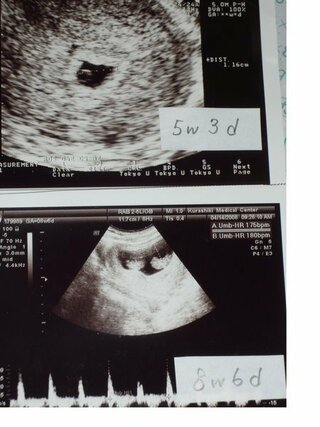 只今妊娠８週の妊婦です 気になってエコー写真を見たんですけどこれって Yahoo 知恵袋