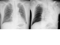 無気肺ってレントゲンだけで診断は出来るんですか わかるも Yahoo 知恵袋