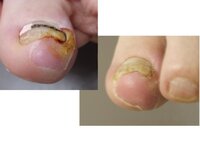 巻き爪について質問です 巻き爪になっている指の爪と肉の間にコ Yahoo 知恵袋