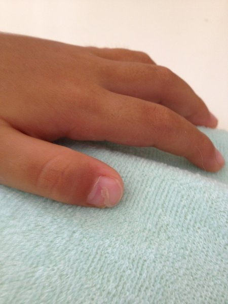 約1ヶ月前に手足口病になった娘の爪が剥がれかけてます いろんなblogやサイト Yahoo 知恵袋