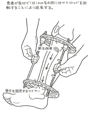 身長を伸ばす治療について 私は 高1で4月に測った時153 8cm 43 Yahoo 知恵袋