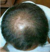 つむじが大きい人と禿げの違いってなんですか 簡単です Yahoo 知恵袋