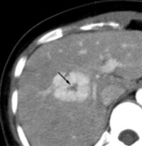 先月 ｃ型肝炎の治療が 完了し完治しました その時ｃｔ検査をしましたが 何や Yahoo 知恵袋