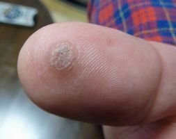 ウィルス性イボの民間治療について 1 2年前から片足の裏に小さな埋まって Yahoo 知恵袋