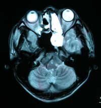 副鼻腔炎と診断されてきたんですが違う病院でなんともないと言わ Yahoo 知恵袋