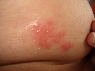 帯状疱疹について質問お願いします。おととい皮膚科にて帯状疱疹か 