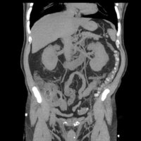 大腸憩室炎を疑わないヤブ内科医って多いのですかね 上行結 Yahoo 知恵袋