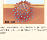 顔にしこり 前に右ほっぺに ニキビができて放置しておいたら痕がのこってし Yahoo 知恵袋