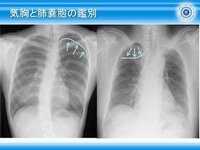 タバコが原因の気胸について 最近タバコをすうと右の肺辺りに違和 Yahoo 知恵袋