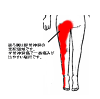 右鼠径部から いきなり 左鼠径部に痛みが転移し 左大腿部に痛みが出る場合は坐 Yahoo 知恵袋