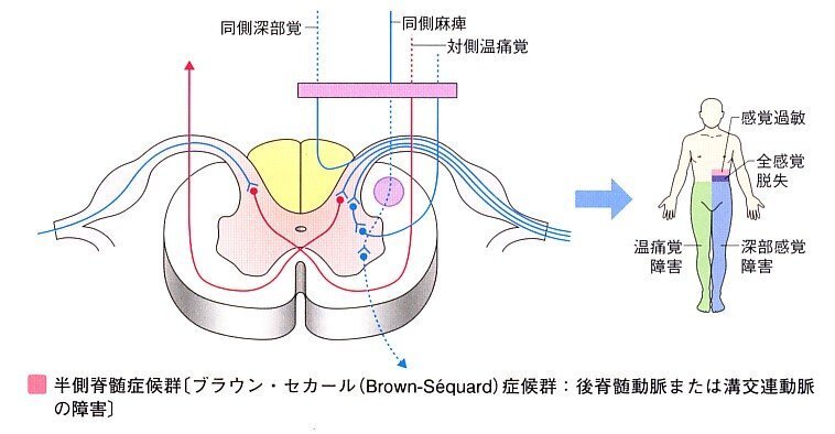 脊髄半側切断症候群(ブラウン・セカール症候群)ってなに？ – ブラウンセガール症候群 画像 – PNFW