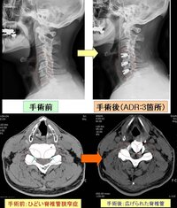 頚椎性神経根症で仕事辞めたいです 職場にはこの症状は言ってはいませんが Yahoo 知恵袋