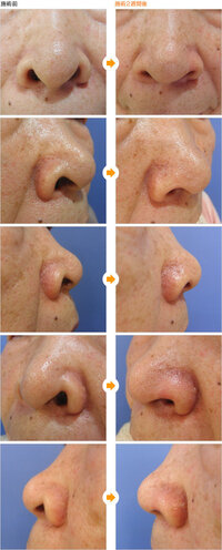 横から見ると鼻の穴が見えてしまいます 僕は鼻にコンプレックスを持 Yahoo 知恵袋