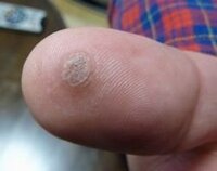 腕にイボがあります小学生の頃から腕に小さなイボがあり それが大 Yahoo 知恵袋