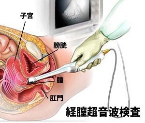 腹部超音波検査の結果のみで 子宮癌の断定はされるものですか 子宮癌は Yahoo 知恵袋