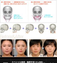 整形手術で顎の骨など削った場合 再生して元の大きさに戻るということはありますか Yahoo 知恵袋