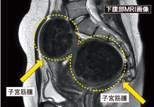 人間ドックで腹部エコー検査をしました ドック終りの診断で 子宮に5センチ Yahoo 知恵袋