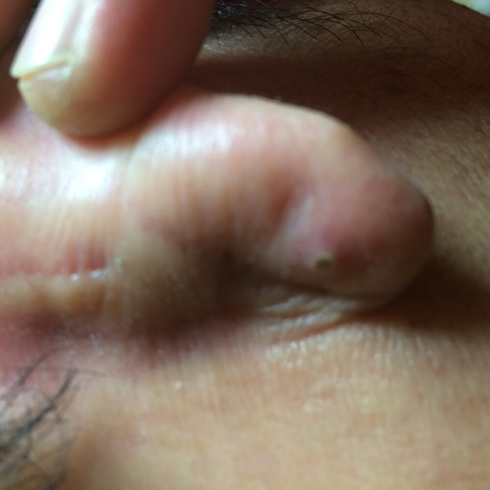 耳の裏には 角栓ってよくできるんですか なんだか 出来るよ Yahoo 知恵袋