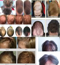 Agaで悩んでおります 今までプロペシアとミノキシジルを飲みまし Yahoo 知恵袋