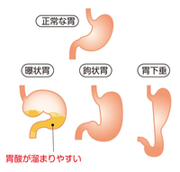 胃下垂を治すには 倒立がいいと言いますが 倒立ができません 首立て Yahoo 知恵袋