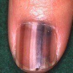 高校生でもメラノーマになったりしますか 足の小指の爪に黒い横線見た Yahoo 知恵袋