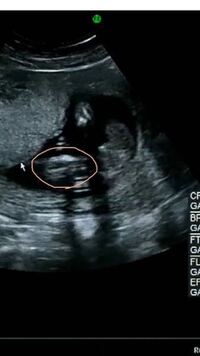 赤ちゃんの性別判定お願いします wのエコーです 病 Yahoo 知恵袋