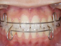 現在矯正をやっているのですが一昨日 2 26 からリテーナーになりました しか Yahoo 知恵袋