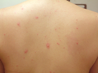 現在妊娠34週の妊婦ですが夫が帯状疱疹にかかってしまいました ネットで Yahoo 知恵袋