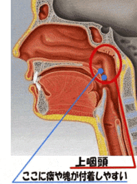 喉の奥の突き当ったところの上に 何やら痰の硬い塊が引っ掛かっては取れ ま Yahoo 知恵袋