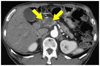 膵臓癌って末期でもctや超音波検査などで見つからないことってありますか 大体 Yahoo 知恵袋