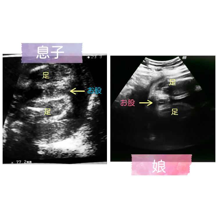 19週エコー 性別判断お願いします 先生は今の時期は男の子も女の子も似てるか Yahoo 知恵袋