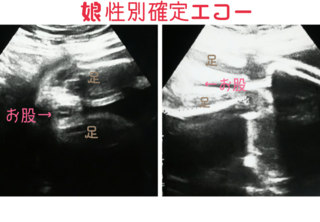 性別エコーについて 木の葉ぽいのが見えたけど男の子だったってかたって Yahoo 知恵袋