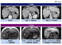 人間ドックの腹部単純mriで肝臓に１０ミリほどの腫瘍が見つかり Yahoo 知恵袋