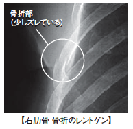 肋骨の打撲について転んで受け身が取れず脇腹から落ちました レントゲ Yahoo 知恵袋