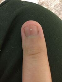 爪の黒い線のような 点のようなものが 気になります メラノーマとは違 Yahoo 知恵袋