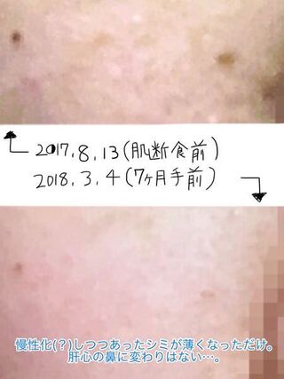 レンチ 糞 煙 ニキビ 跡 ケシミン Kanagawabuilding Jp