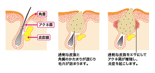 ニキビがある時に化粧水つけるのはやめた方が良いのですかね 化粧水は Yahoo 知恵袋