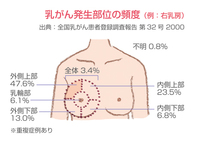 乳がんのしこりは 脇の胸の下にあるって決められてるのですか なんか 私 Yahoo 知恵袋