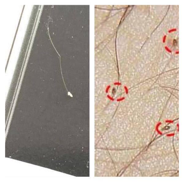 毛根鞘について - ドライヤーしてたら抜けた毛の根元に白い塊がつ 
