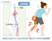 坐骨神経痛と筋トレ教えてください 病院の診断では無いのですが整骨院と Yahoo 知恵袋