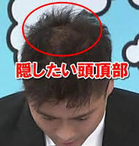 ジャニーズにハゲが少ないのは何故でしょうか かつら ですね も Yahoo 知恵袋