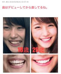 Auの有村架純の歯は白すぎますよね 青光りしていますけど何をしてます Yahoo 知恵袋