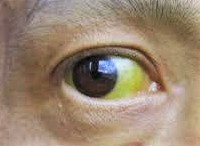 黄疸とは、本当に誰の目で見ても分かるような黄色ですか？黄疸になると 