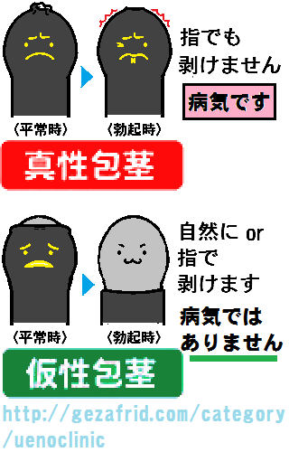 読み方 包皮輪狭窄